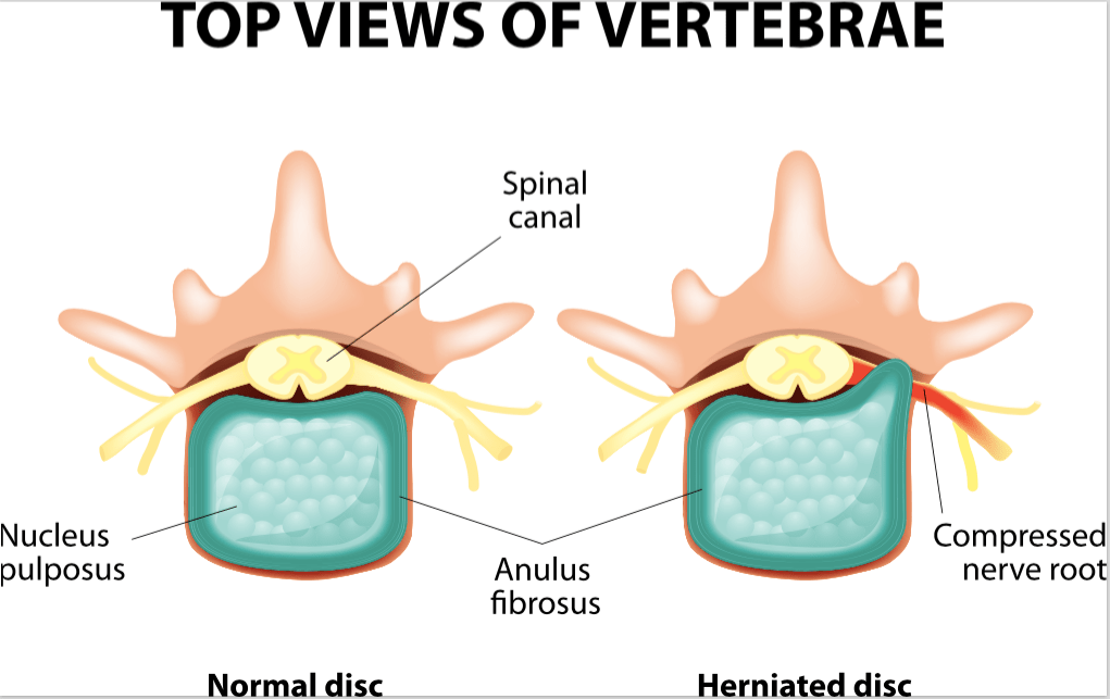 Lumbar Microdiscectomy