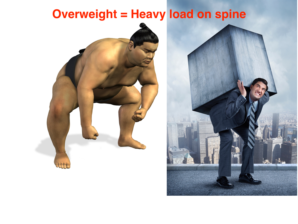 Obesity causes low back pain