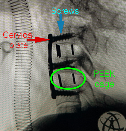 Anterior cervical discectomy and plating