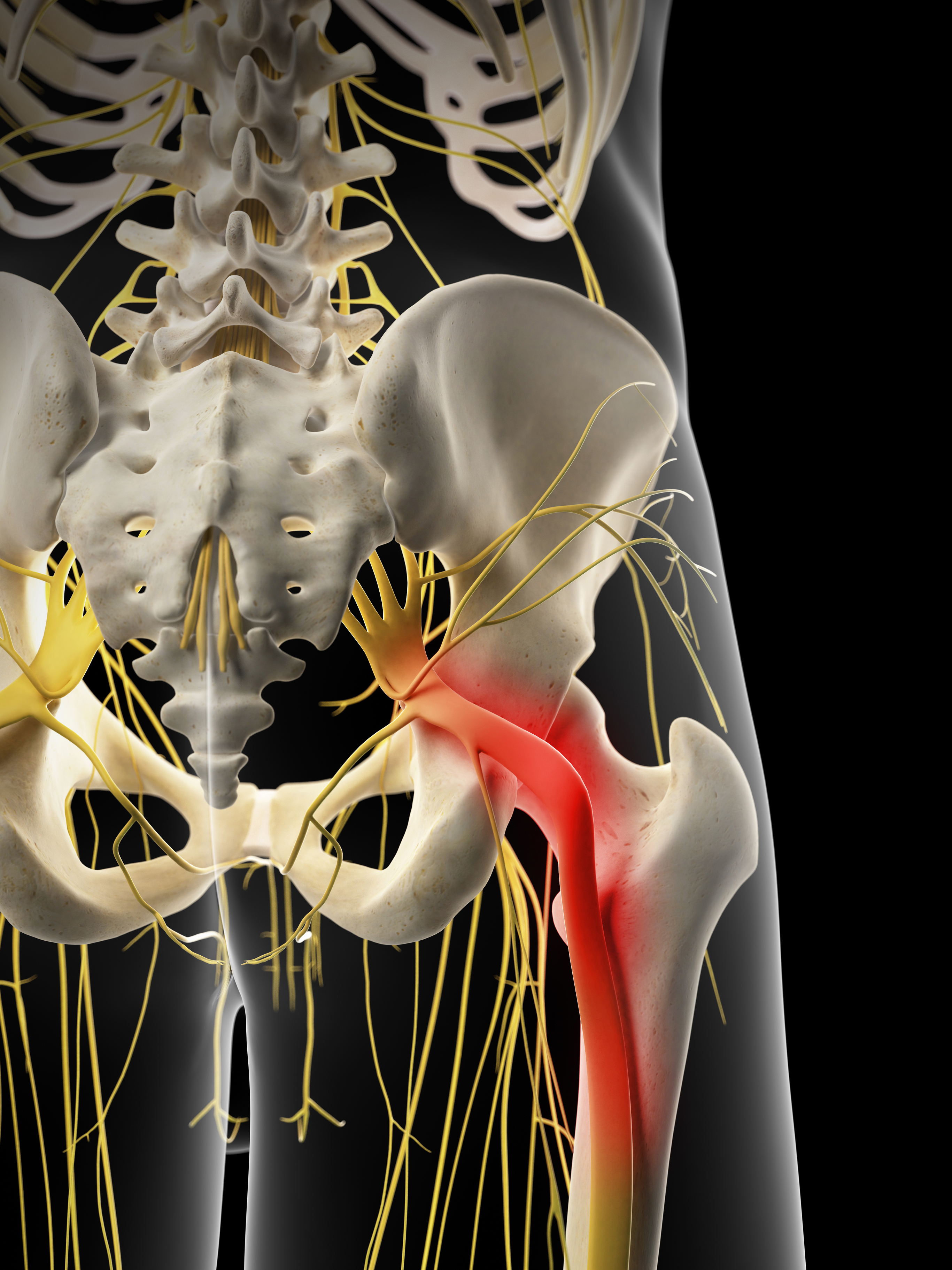 What is Sciatica pain