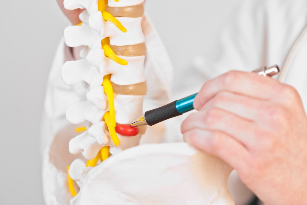 L45 Microdiscectomy- Best Spine Surgeon in Gurugram